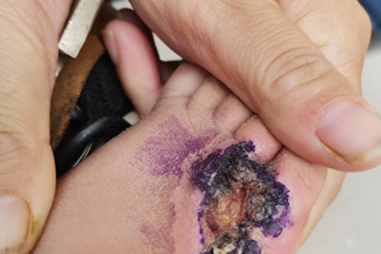 三度烫伤结痂图 三度烫伤结痂图