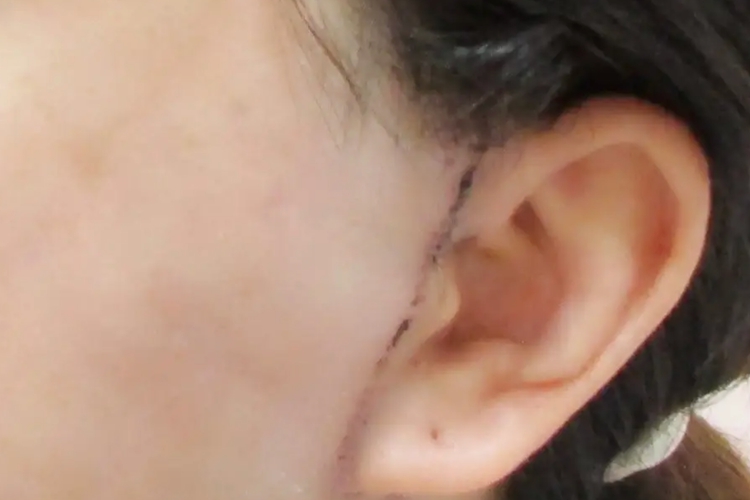 大拉皮手术15天切口图