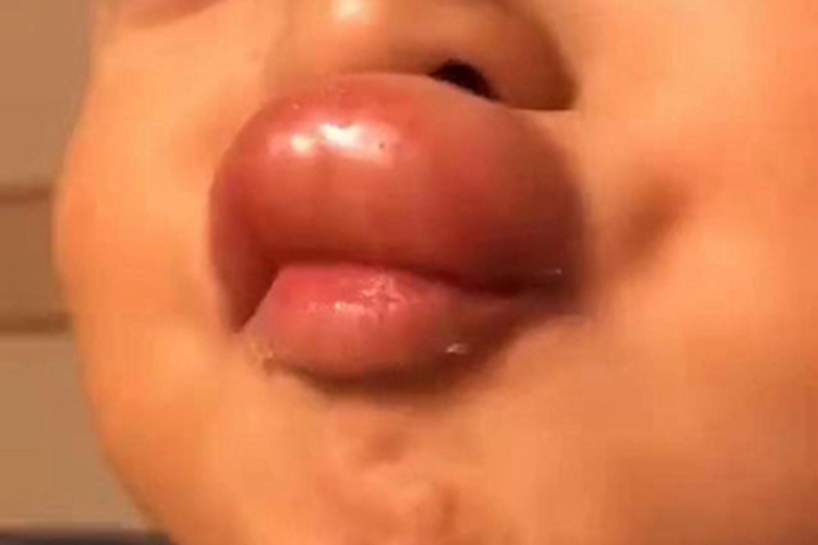 蜂蜇伤上嘴唇肿胀图