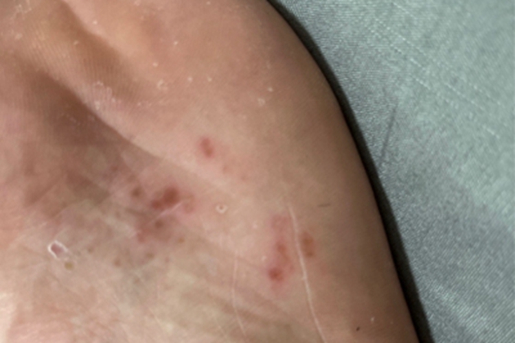 汗疱疹脚底红斑图