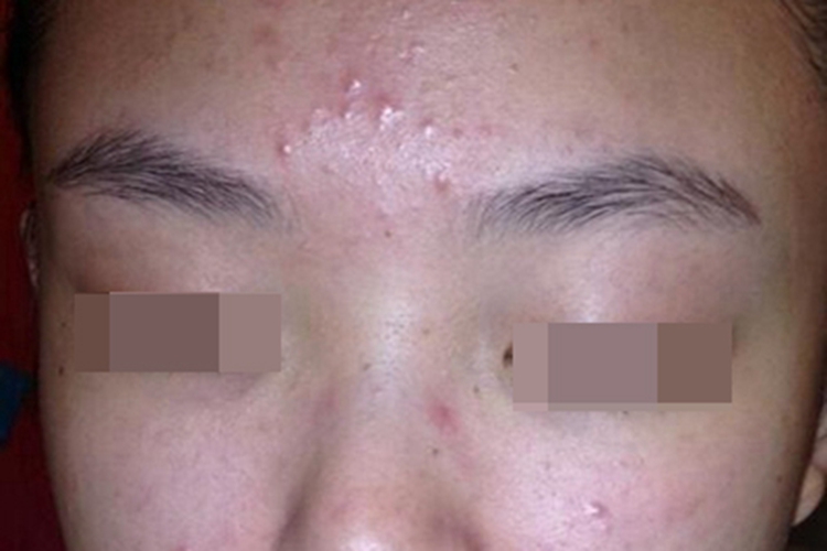 丘疹脓疱型玫瑰痤疮丘疹