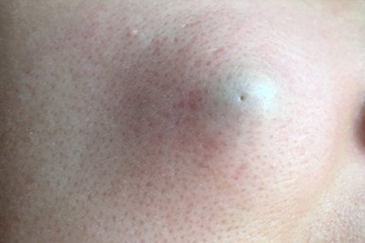 肉里长硬疙瘩皮脂腺囊肿图 肉里长硬疙瘩皮脂腺囊肿图