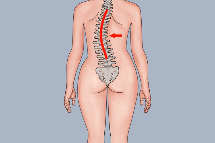 脊柱侧凸图 脊柱侧凸图