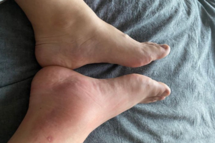 蜂蜇伤脚踝红肿图 蜂蜇伤脚踝红肿图