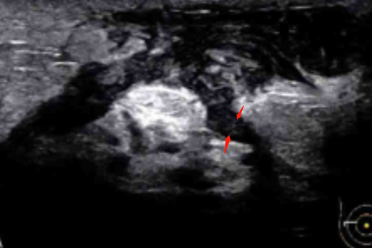 乳腺导管扩张Ⅳ型超声图