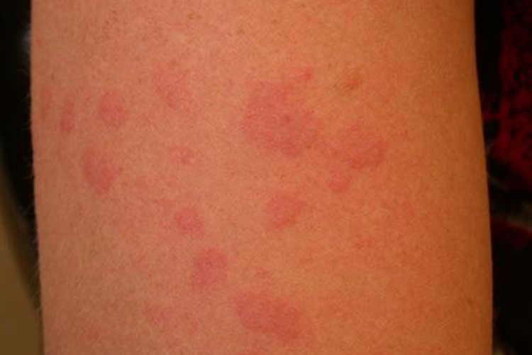 日光性荨麻疹手臂紫外线过敏图