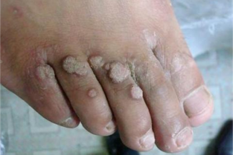 疣状表皮发育不良脚趾疙瘩图