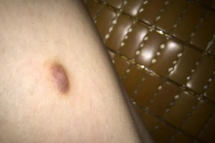 大腿皮肤纤维瘤图