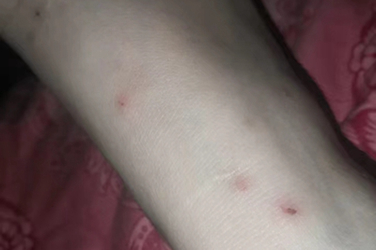 跳蚤叮咬脚踝小疙瘩图