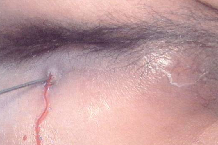 囊肿破溃流脓图