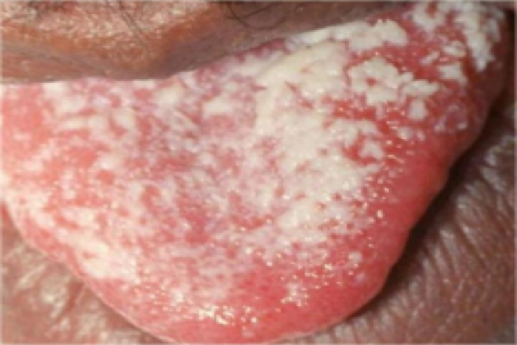 急性假膜型念珠菌性口炎图