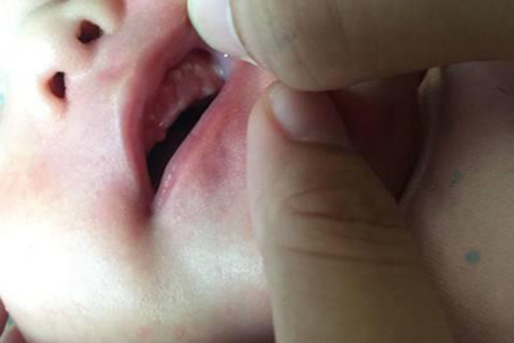 马牙上牙龈有小疙瘩图