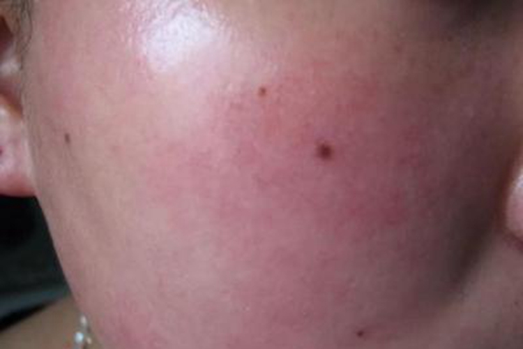 一氧化碳中毒面部红肿图 一氧化碳中毒面部红肿图