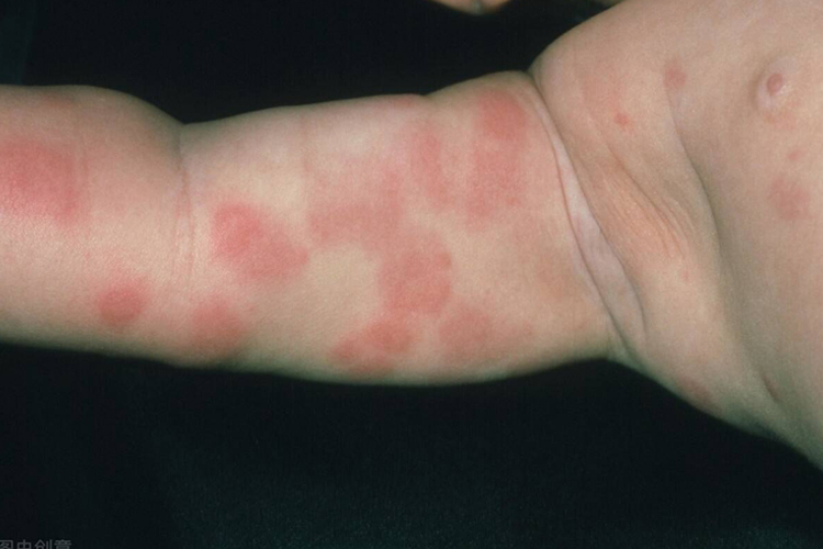 卡介苗过敏性皮疹图