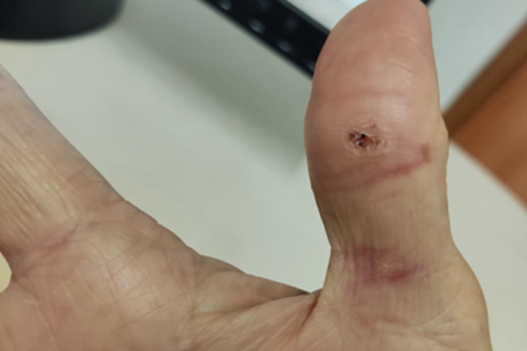 寻常疣手指糜烂图 寻常疣手指糜烂图