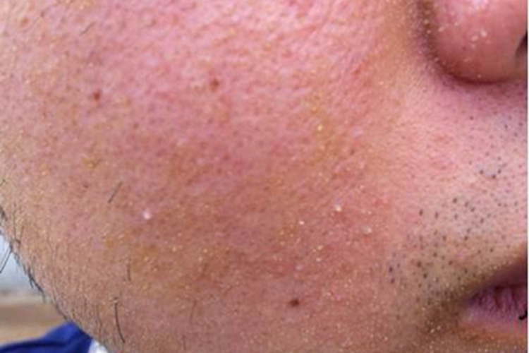 慢性接触性皮炎面部丘疹图 慢性接触性皮炎面部丘疹图