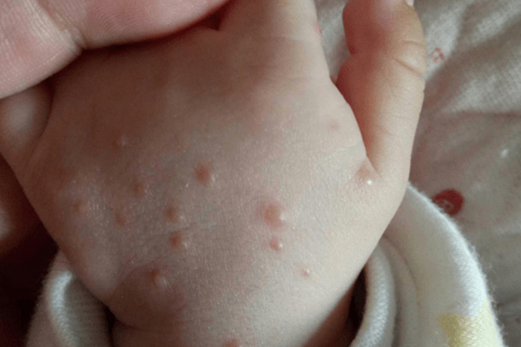 水痘手背水疱图 水痘手背水疱图
