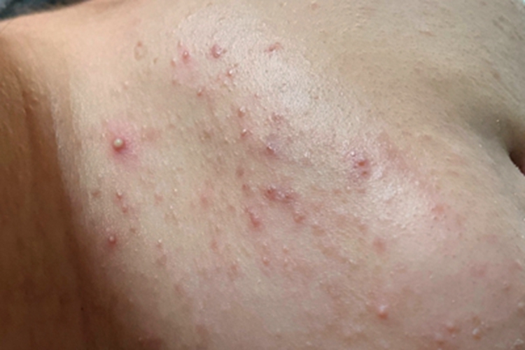 马拉色菌毛囊炎下巴症状图 马拉色菌毛囊炎下巴症状图