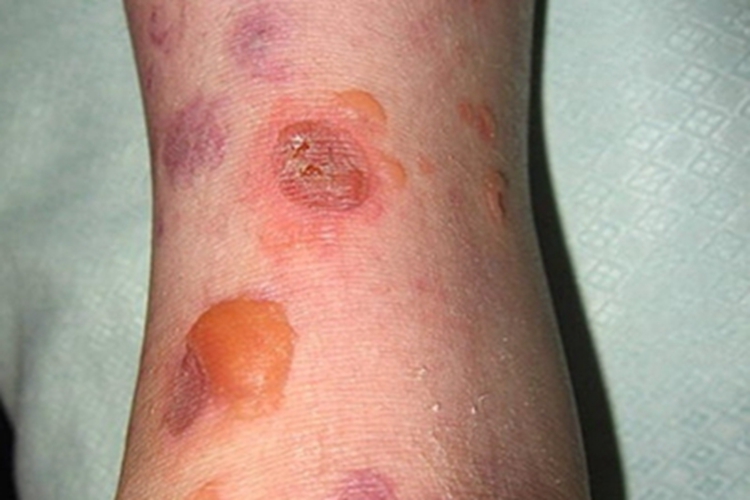 大疱性表皮松解症脚踝结痂图