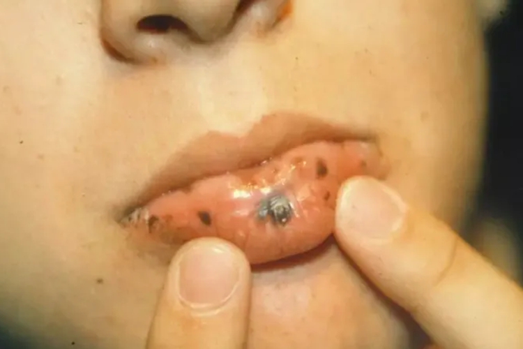 肠息肉嘴唇黑斑图