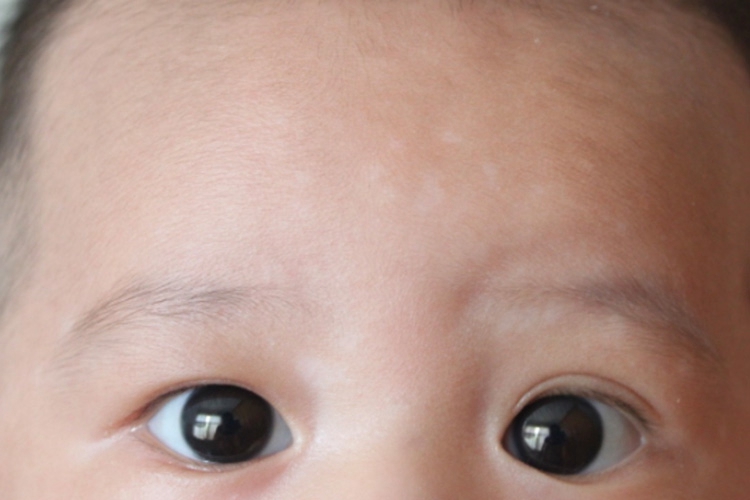 花斑糠疹小儿白斑初期图