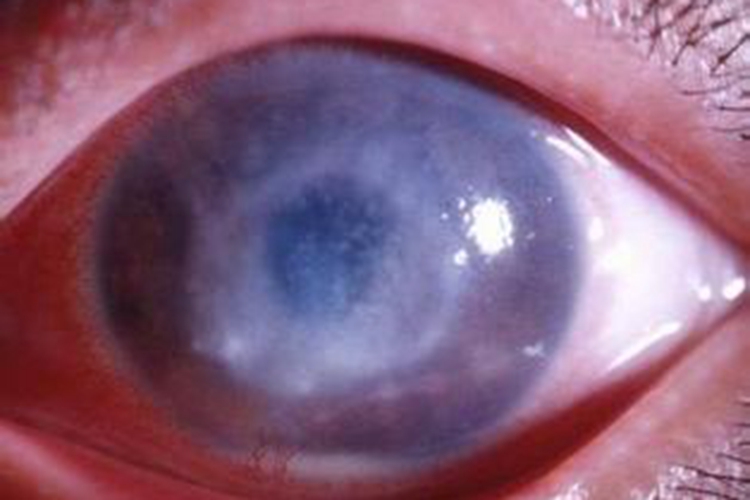 角膜溃疡角膜水肿图