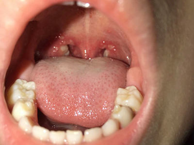 疱疹性咽炎咽喉红肿有白色溃疡图