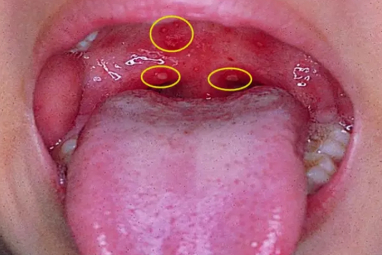 小儿疱疹性咽峡炎口腔红肿图