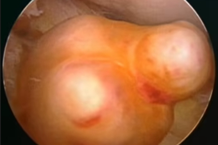 耵聍腺肿瘤外耳道症状图 耵聍腺肿瘤外耳道症状图