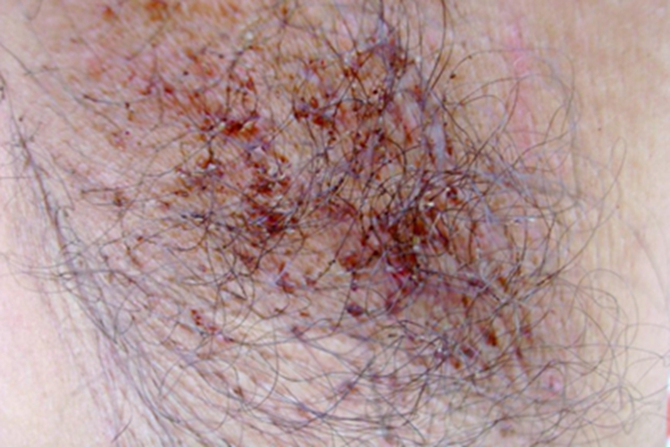 阴虱病结痂图 阴虱病结痂图