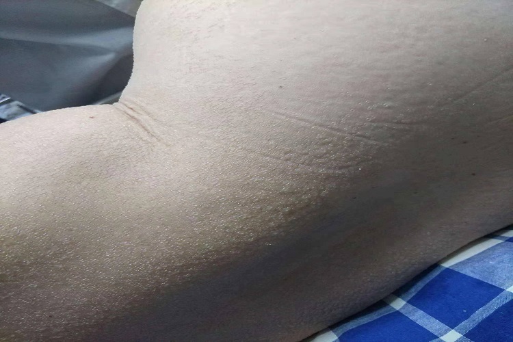 身上起白痱子图