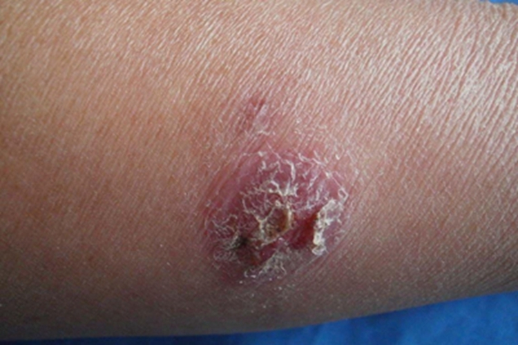 组织胞浆菌病结痂图