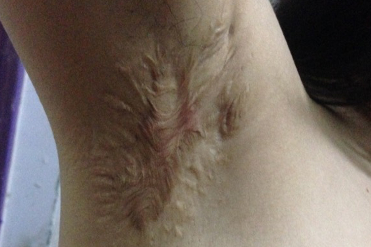 腋下祛疤修复前图 腋下祛疤修复前图