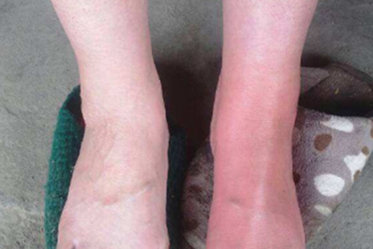 蜂窝织炎脚部发红图