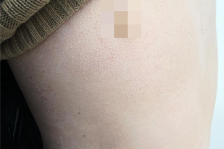 小棘苔藓小疙瘩图 小棘苔藓小疙瘩图