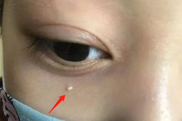 下眼皮粟丘疹图