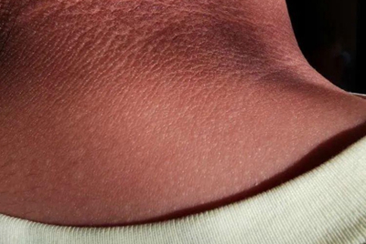 假性黑棘皮病皮肤粗糙图