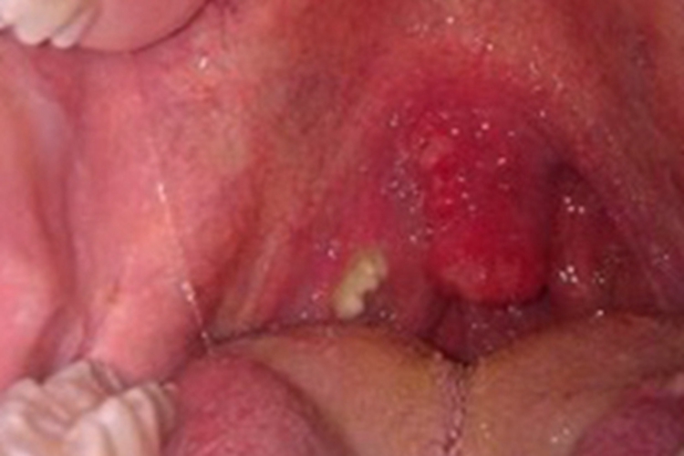 扁桃体结石症状图