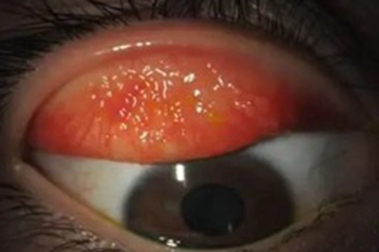 腺病毒性角结膜炎眼睑红肿图