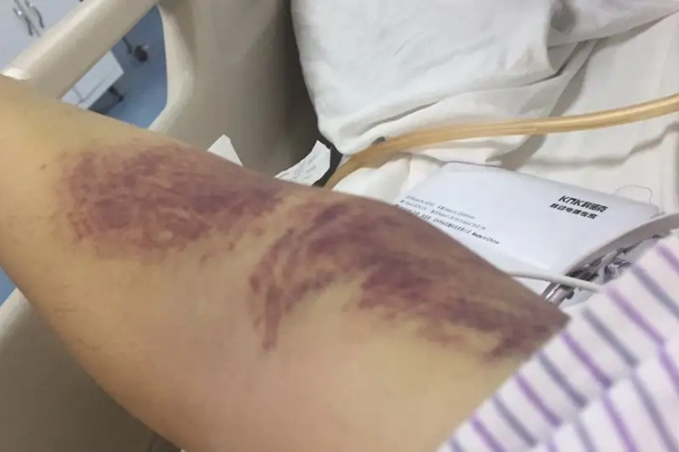 血栓性血小板减少性紫癜图