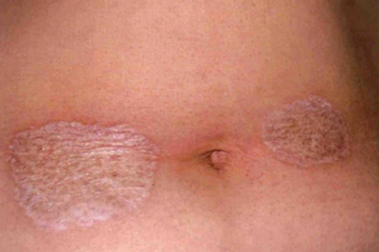 硬化萎缩性苔藓红斑图