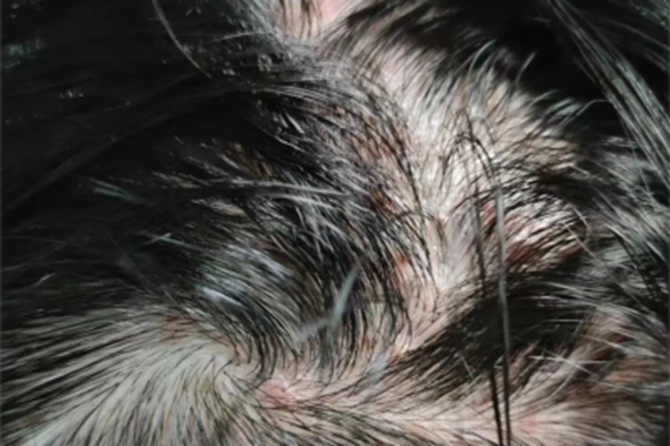 马拉色菌毛囊炎头皮丘疹图 马拉色菌毛囊炎头皮丘疹图