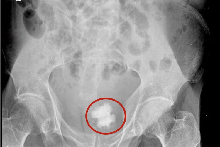 膀胱片状结石影像图