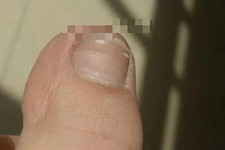 甲营养不良脚趾甲白点图