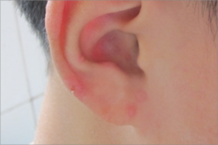单纯疱疹耳部红斑图
