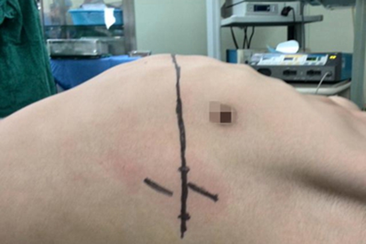 鸡胸胸部变形图