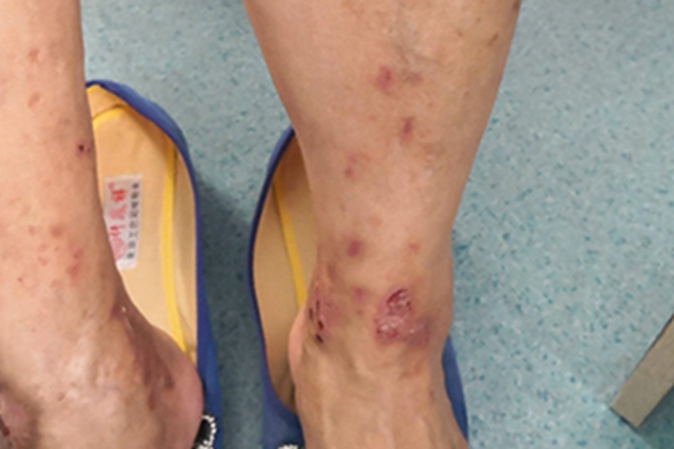 夏季皮炎小腿症状图 夏季皮炎小腿症状图
