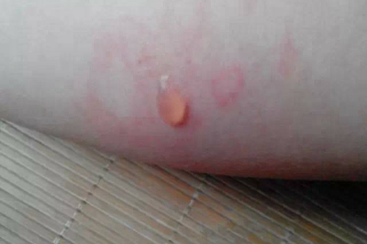 甲虫皮炎小腿单发大水疱图 甲虫皮炎小腿单发大水疱图