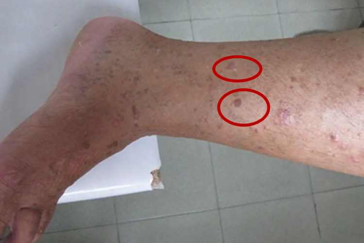 灰泥角化病丘疹图