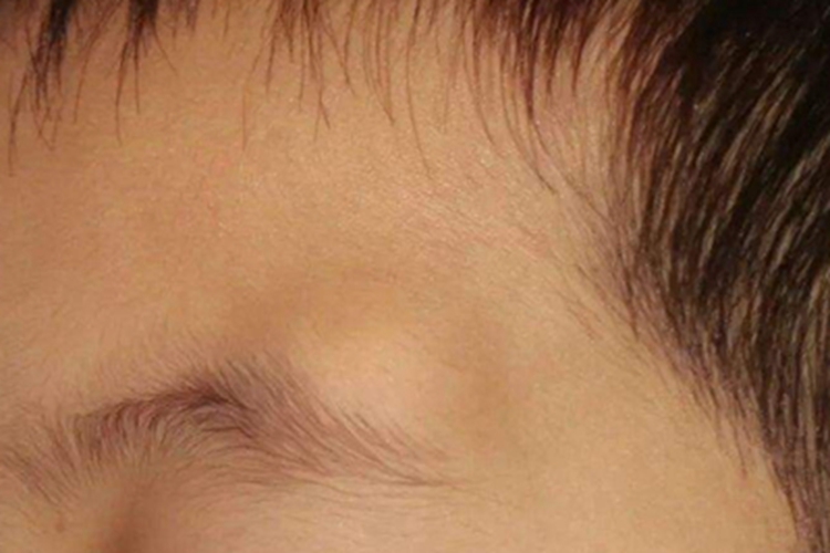 眼眶皮样囊肿疙瘩图